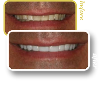 Before and after smile makeover, case 1, treated at Ingleside Family Dental in Ladson, SC