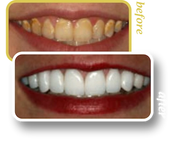 Before and after smile makeover, case 10, treated at Ingleside Family Dental in Ladson, SC