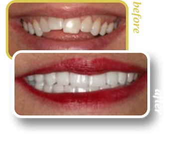 Before and after smile makeover, case 11, treated at Ingleside Family Dental in Ladson, SC