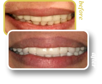 Before and after smile makeover, case 12, treated at Ingleside Family Dental in Ladson, SC