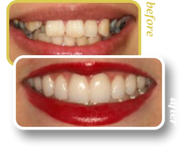 Before and after smile makeover, case 13, treated at Ingleside Family Dental in Ladson, SC