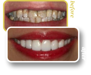 Before and after smile makeover, case 14, treated at Ingleside Family Dental in Ladson, SC