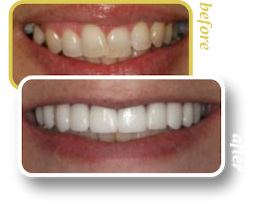 Before and after smile makeover, case 15, treated at Ingleside Family Dental in Ladson, SC