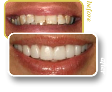 Before and after smile makeover, case 16, treated at Ingleside Family Dental in Ladson, SC