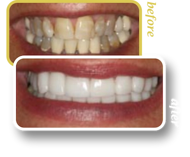 Before and after smile makeover, case 17, treated at Ingleside Family Dental in Ladson, SC