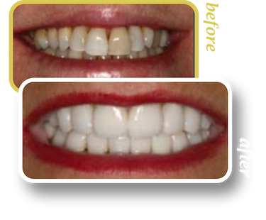 Before and after smile makeover, case 18, treated at Ingleside Family Dental in Ladson, SC