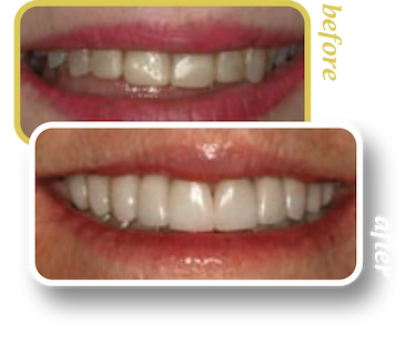 Before and after smile makeover, case 19, treated at Ingleside Family Dental in Ladson, SC