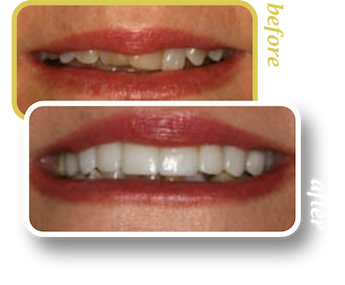 Before and after smile makeover, case 2, treated at Ingleside Family Dental in Ladson, SC