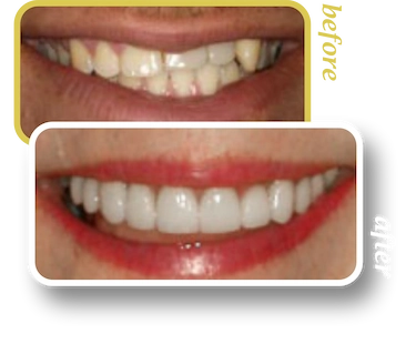 Before and after smile makeover, case 20, treated at Ingleside Family Dental in Ladson, SC