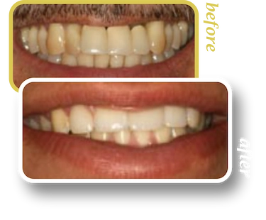 Before and after smile makeover, case 21, treated at Ingleside Family Dental in Ladson, SC