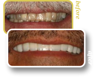 Before and after smile makeover, case 22, treated at Ingleside Family Dental in Ladson, SC