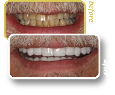 Before and after smile makeover, case 23, treated at Ingleside Family Dental in Ladson, SC