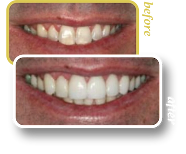 Before and after smile makeover, case 24, treated at Ingleside Family Dental in Ladson, SC