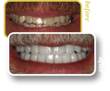 Before and after smile makeover, case 25, treated at Ingleside Family Dental in Ladson, SC