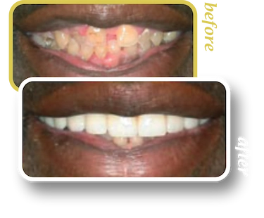 Before and after smile makeover, case 26, treated at Ingleside Family Dental in Ladson, SC