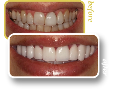 Before and after smile makeover, case 27, treated at Ingleside Family Dental in Ladson, SC
