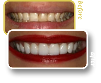 Before and after smile makeover, case 3, treated at Ingleside Family Dental in Ladson, SC
