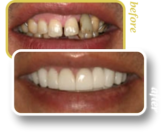 Before and after smile makeover, case 4, treated at Ingleside Family Dental in Ladson, SC