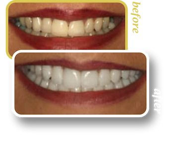 Before and after smile makeover, case 5, treated at Ingleside Family Dental in Ladson, SC