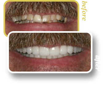 Before and after smile makeover, case 6, treated at Ingleside Family Dental in Ladson, SC