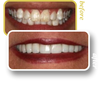 Before and after smile makeover, case 7, treated at Ingleside Family Dental in Ladson, SC