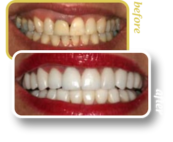 Before and after smile makeover, case 8, treated at Ingleside Family Dental in Ladson, SC