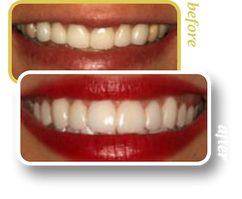 Before and after smile makeover, case 9, treated at Ingleside Family Dental in Ladson, SC