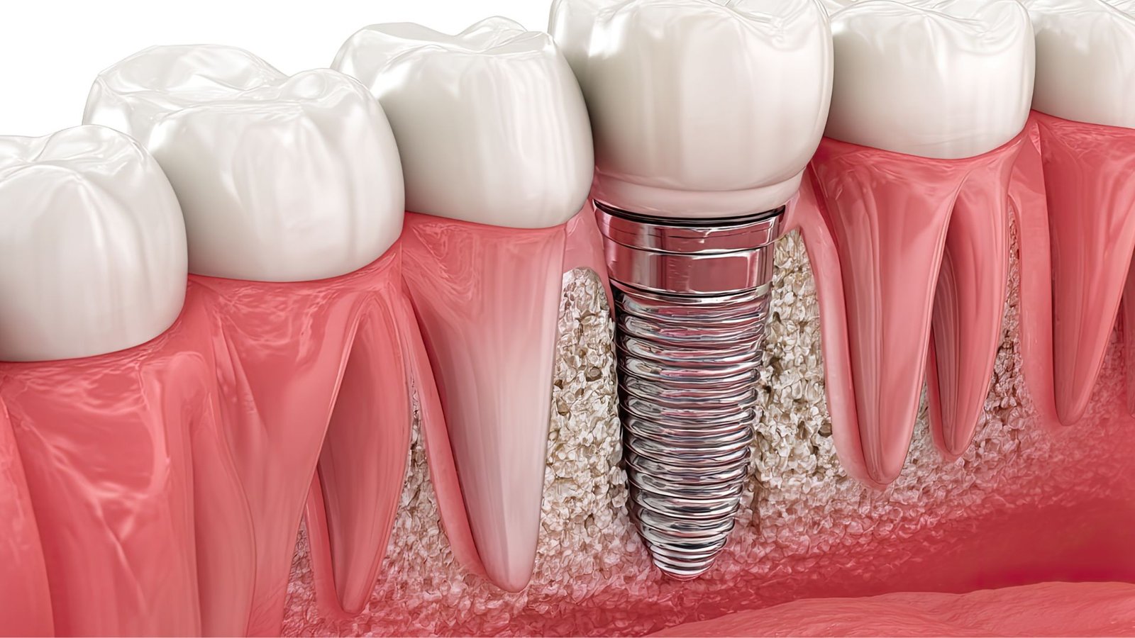 Dental implants in Ladson, SC