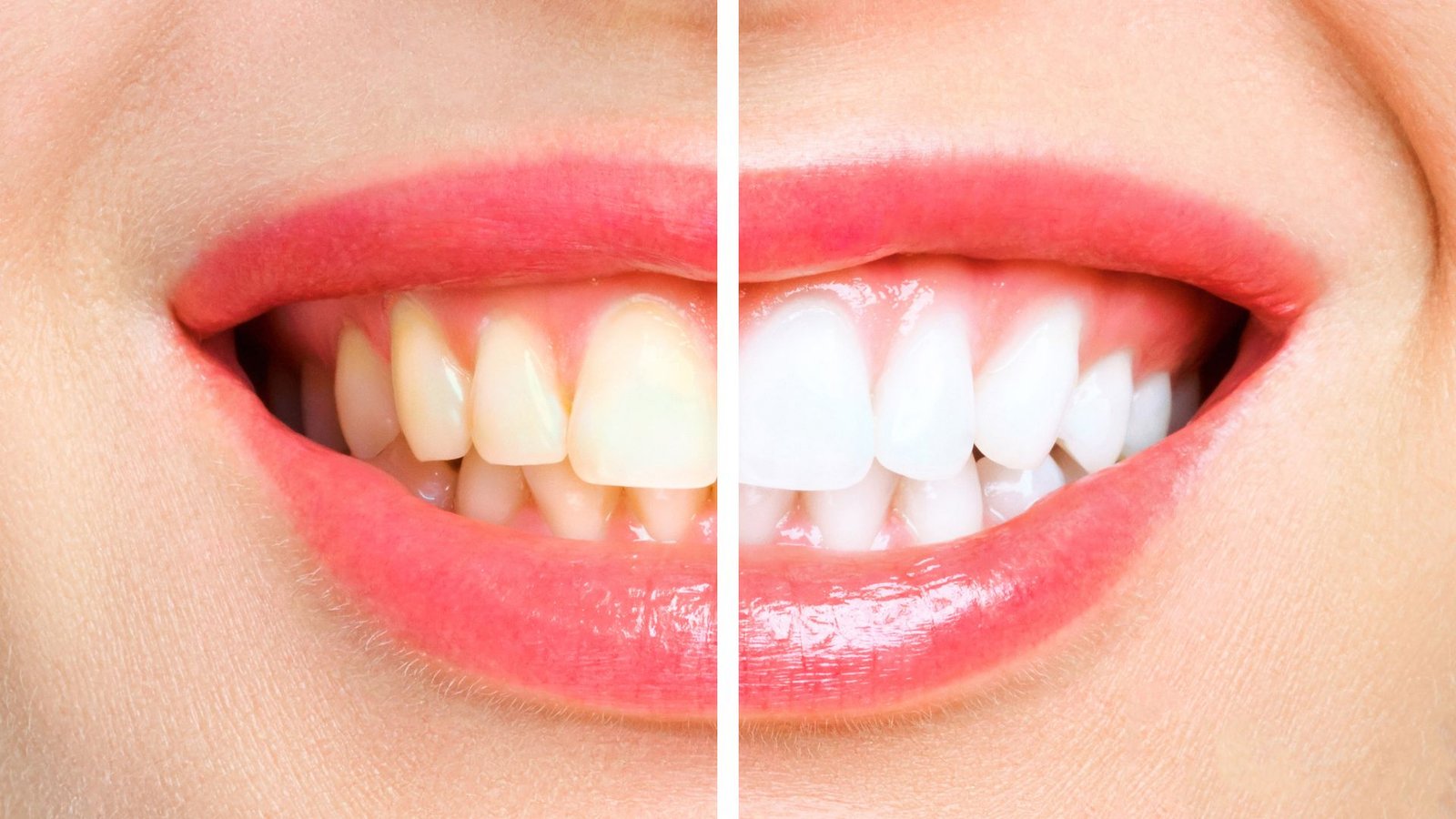 ZOOM in-office whitening in Ladson, SC