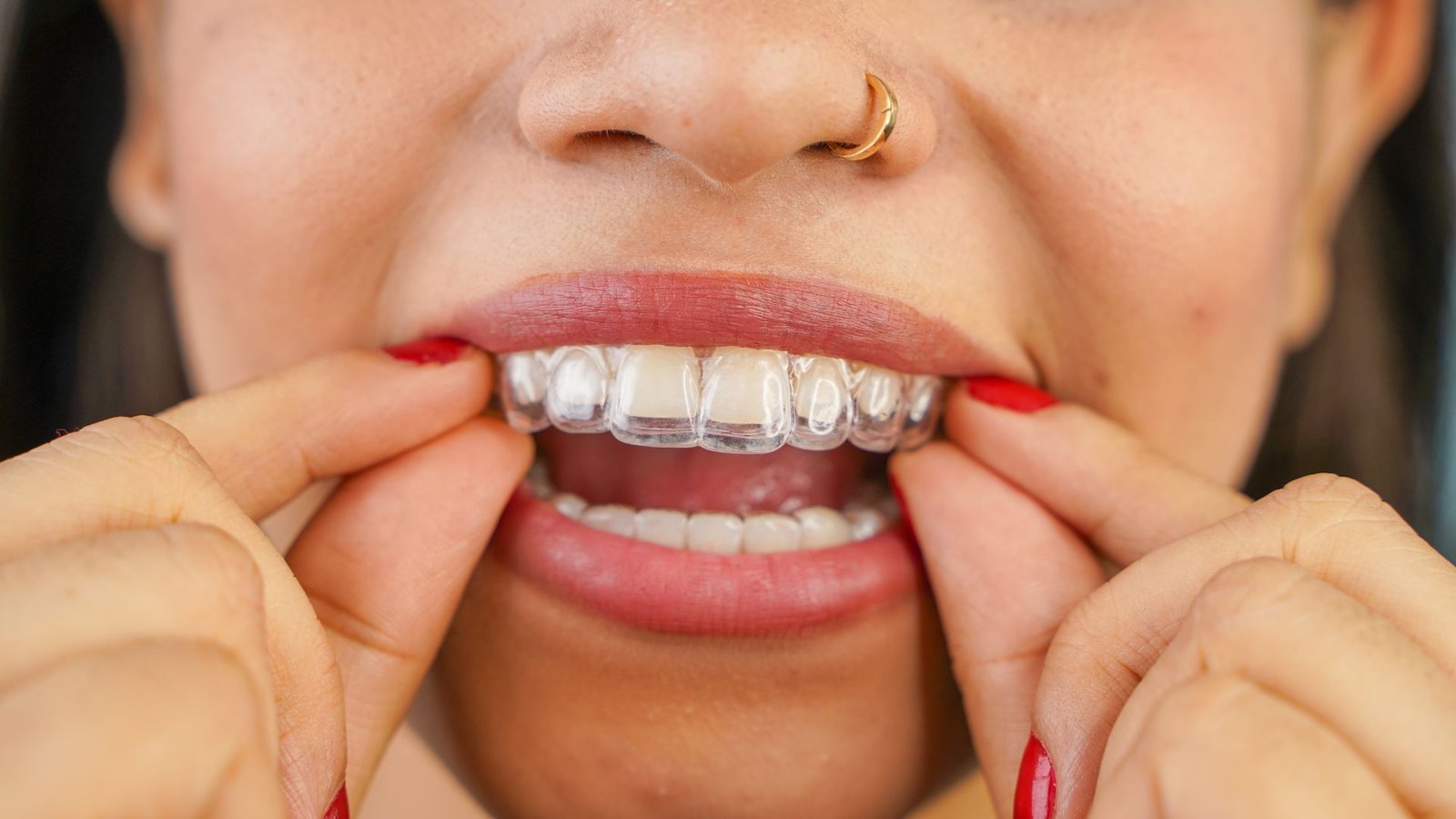 Adult wearing Invisalign clear aligners in Ladson, SC