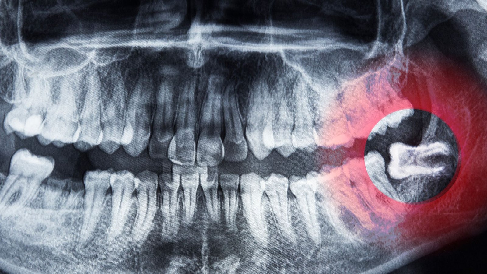 Wisdom tooth extraction in Ladson, SC
